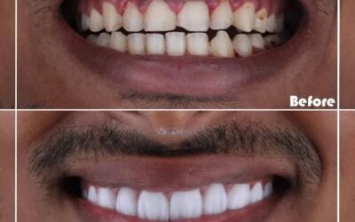 How can I keep my teeth whiter?