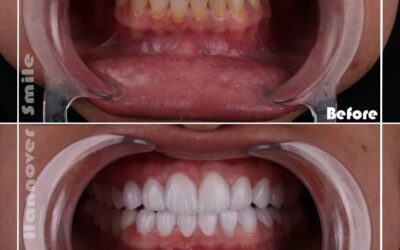 Dental Veneers Without Pain