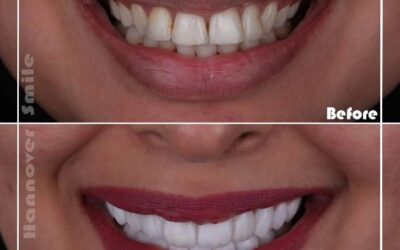 Dental Veneers And Dental Crown