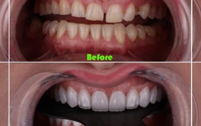 Free Consultation With Experts – Dental Veneers