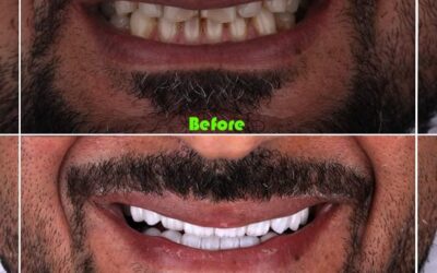 Improve Your Smile Today With Natural Veneers in uae