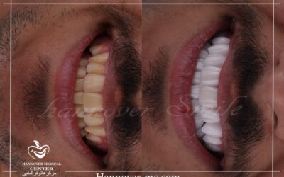 Improve Your Smile Today With Natural Veneers in uae