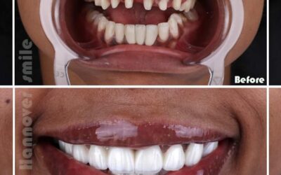 Improve Your Smile Today With Natural Veneers in uae