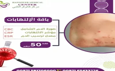 عروض تحاليل الإلتهابات: عروض استثنائية